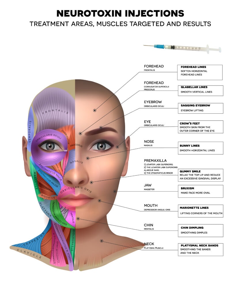 Botox Injections treatment areas, muscles, and its results